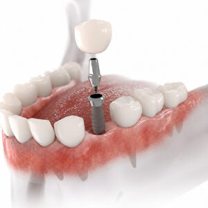 Dental Implants