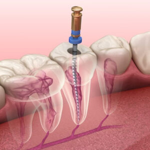 Root Canal Treatment​