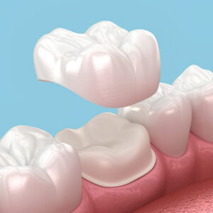 Dental Crowns & Bridges