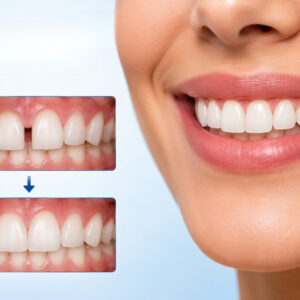 Gap / Diastema Closure