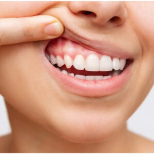 Gum Disease Treatment